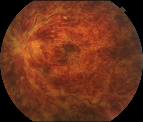 Central Retinal Vein Occlusion