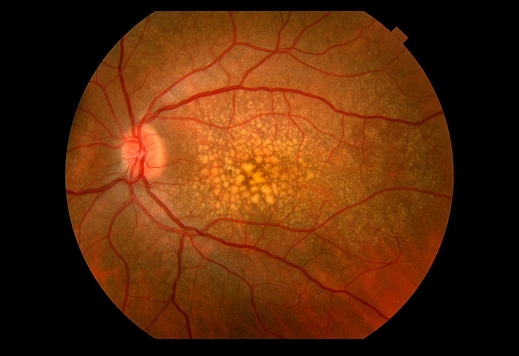 Macular Degeneration Treatment