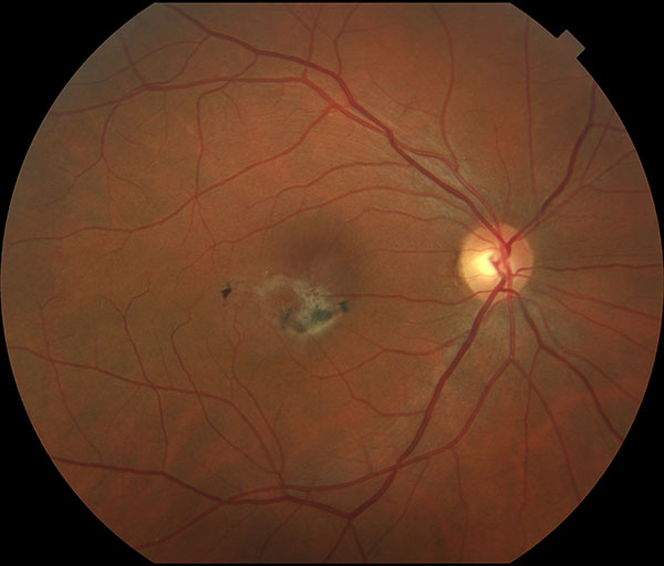 Idiopathic Perifoveal Telangiectasia