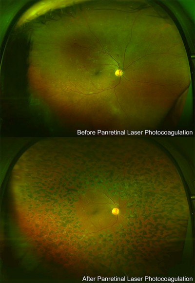 Diabetic Retinopathy Treatment in New York