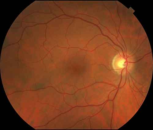 Retinal Detachment NYC - Vitreous Retina Macula Consultants of New