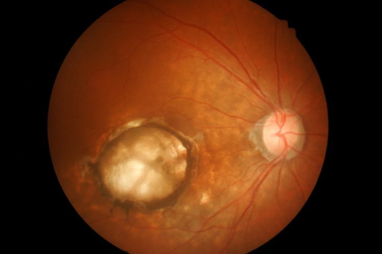 Age-related macular degeneration (AMD)