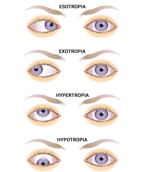 Amblyopia