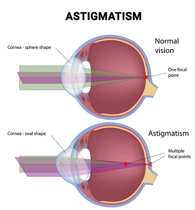 Astigmatism