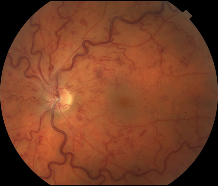 Central Retinal Vein Occlusion