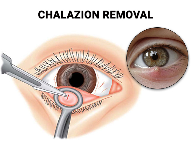 Chalazion Removal