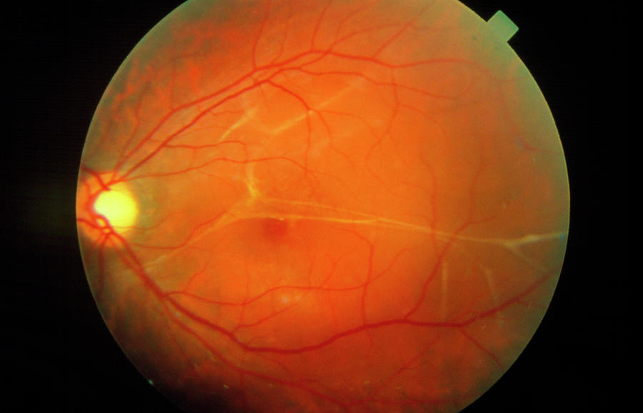 Detached Retina