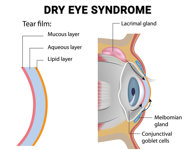 Dry Eye Syndrome