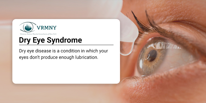 Dry Eye Syndrome