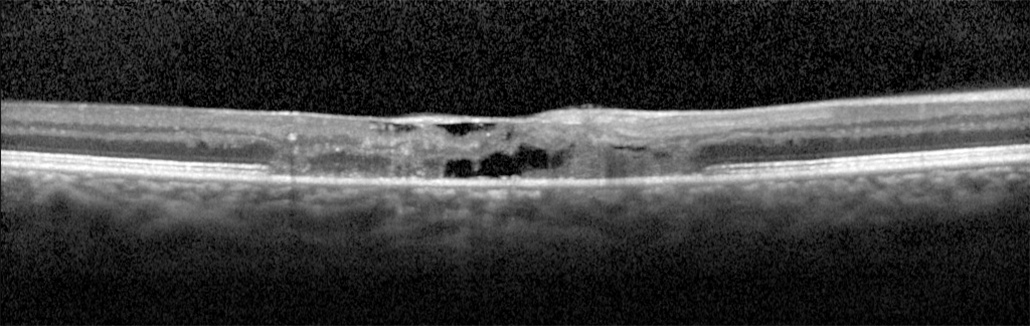 Idiopathic Perifoveal Telangiectasia (IPT-LG)