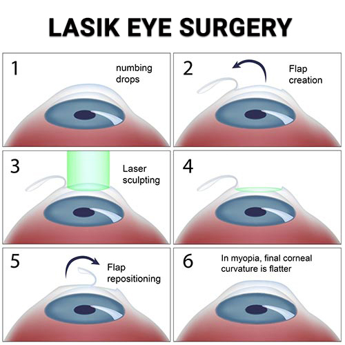 LASIK Eye Surgery in NYC - Vitreous Retina Macula Consultants of New York