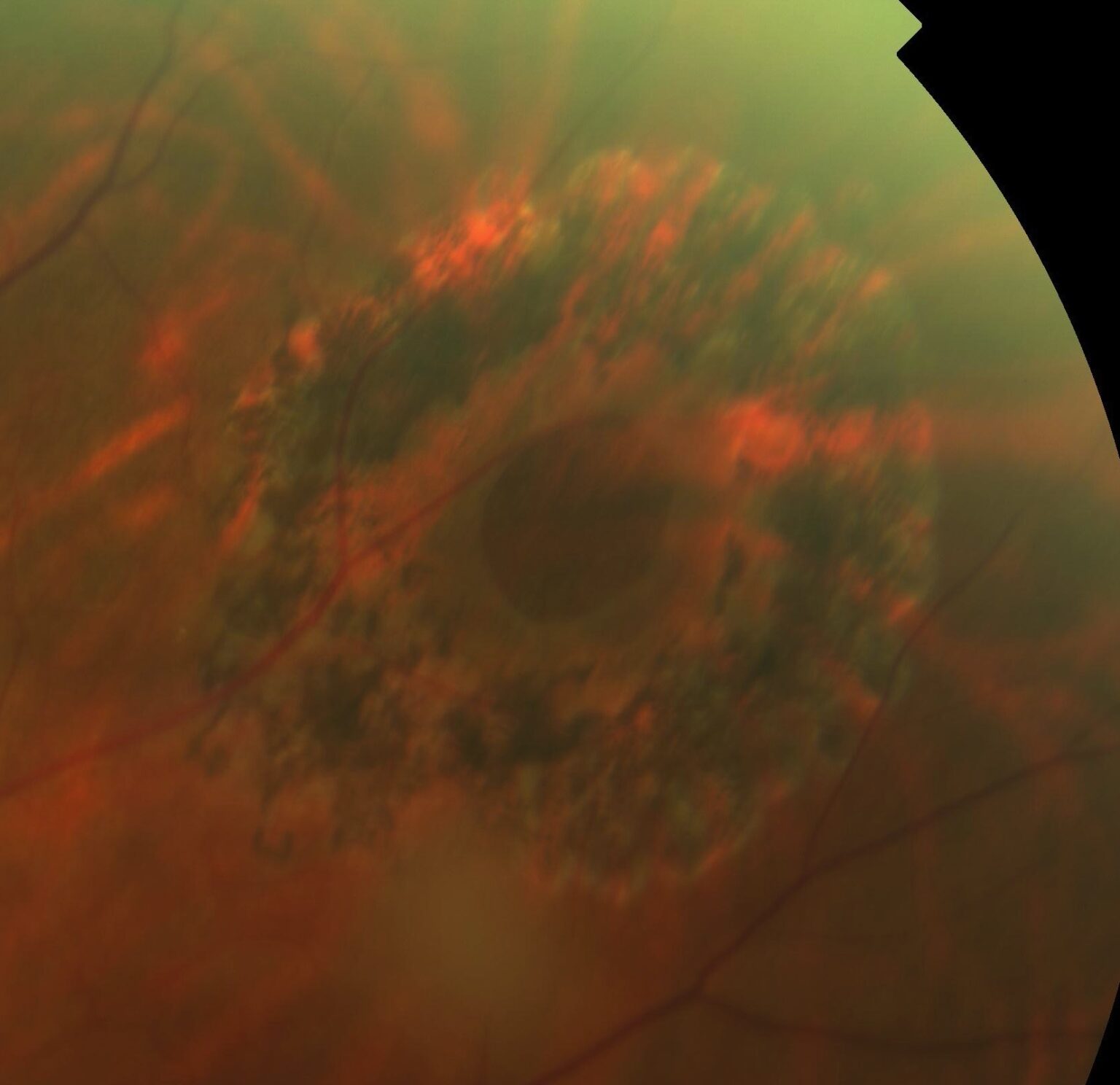 Indirect Laser Retinopexy in NYC Vitreous Retina Macula Consultants