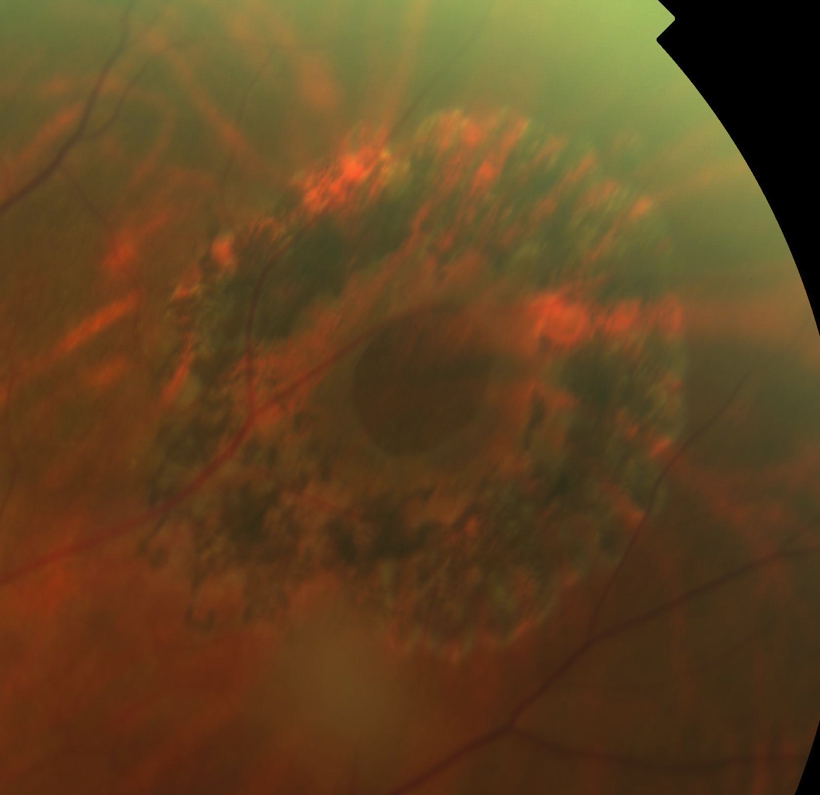 Laser Retinopexy