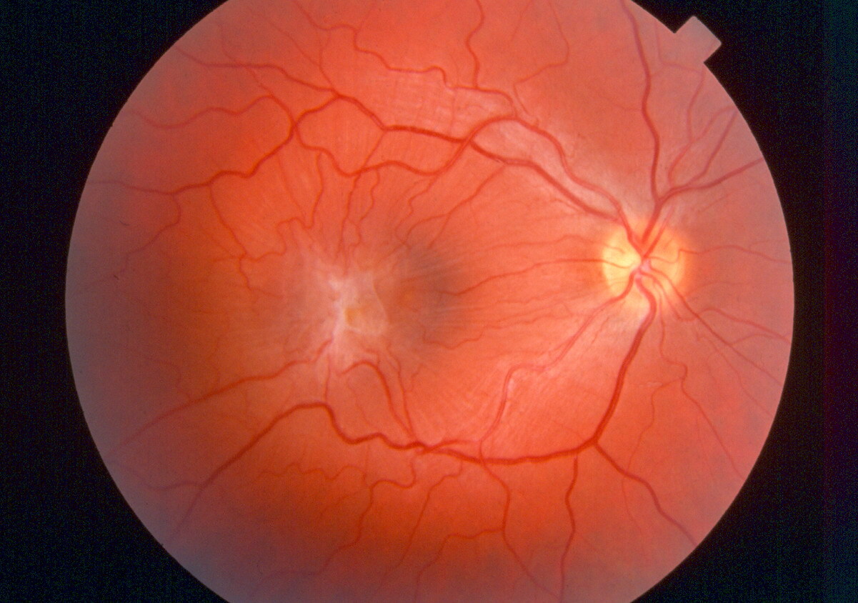 Macular Pucker