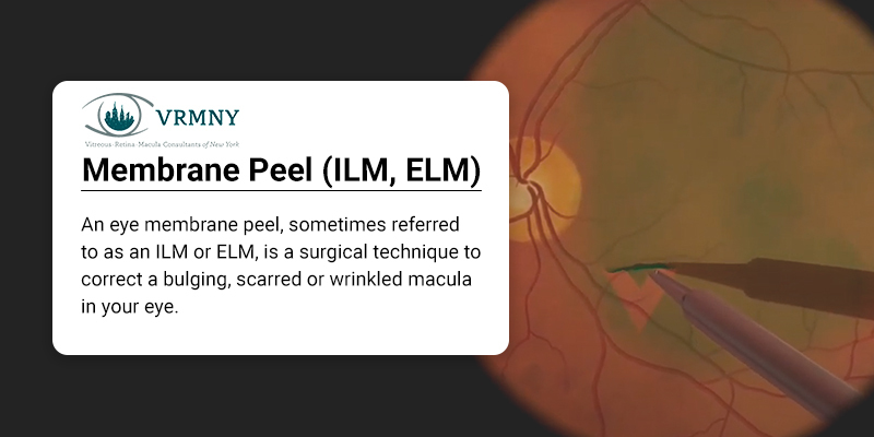 Membrane Peel