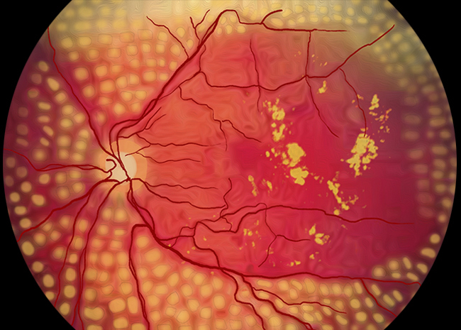 Panretinal Photocoagulation (PRP)