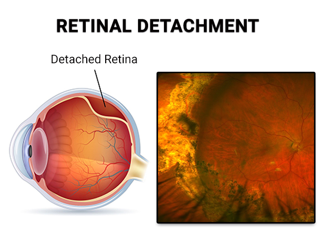 retinal detachment vision