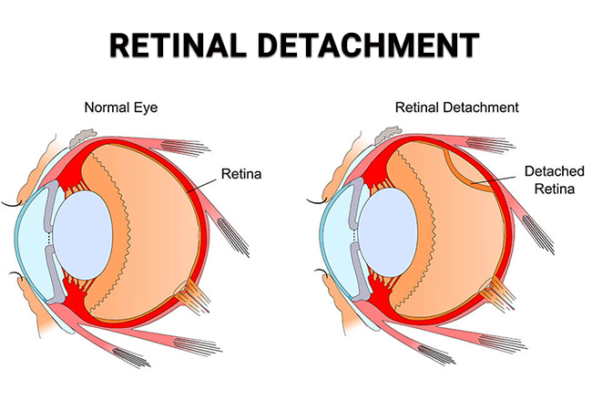Retinal Detachment