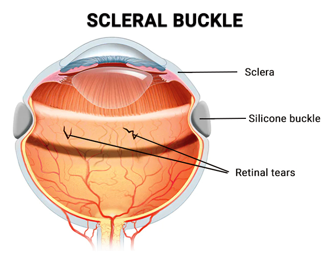 Types of Retinal Detachment, Their Causes, and Treatments