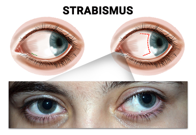 Strabismus (Crossed Eyes) NYC - Treatments For Ocular Misalignment