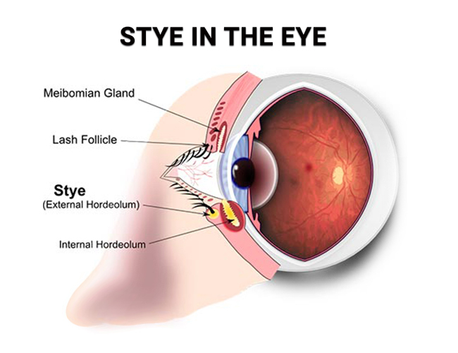 Stye Inside Or Under The Lower Eyelid: Symptoms & Treatment