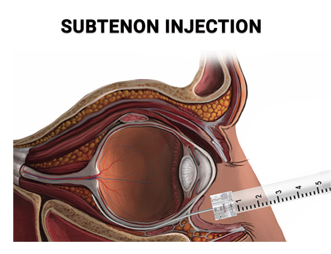 Subtenon Injection