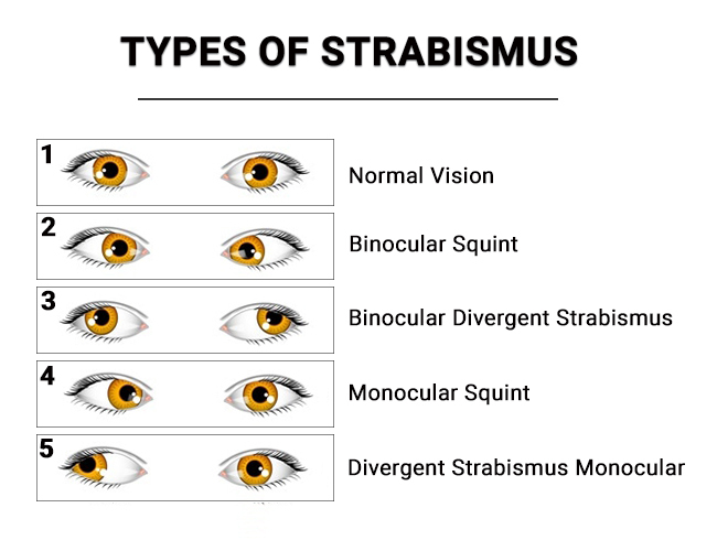 Types of strabismus