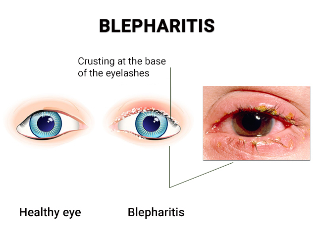 Blepharitis