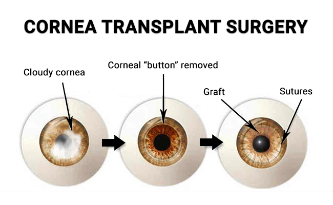 Cornea Transplant