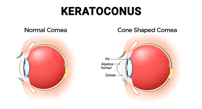 Keratoconus
