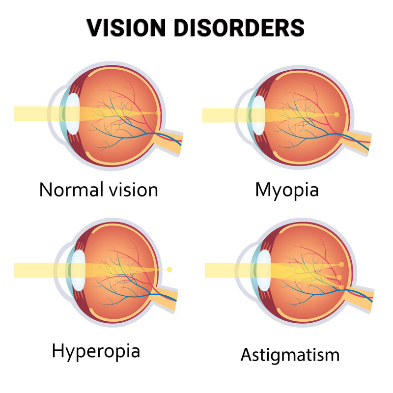 Vision Disorders