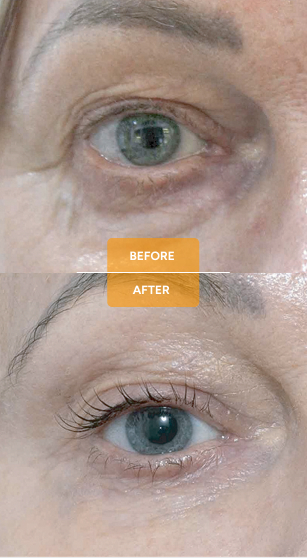 Tixel® for skin rejuvenation before and after case 1