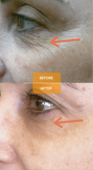 Tixel® for skin rejuvenation before and after case 2