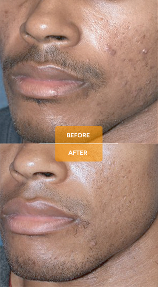Tixel® for skin rejuvenation before and after case 3