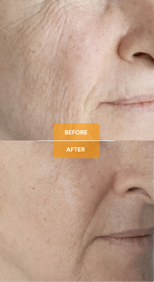 Tixel® for skin rejuvenation before and after case 4