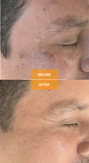 Tixel® for skin rejuvenation before and after case 5