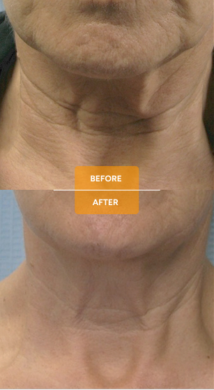 Tixel® for skin rejuvenation before and after case 6