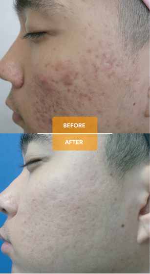 Tixel® for skin rejuvenation before and after case 7