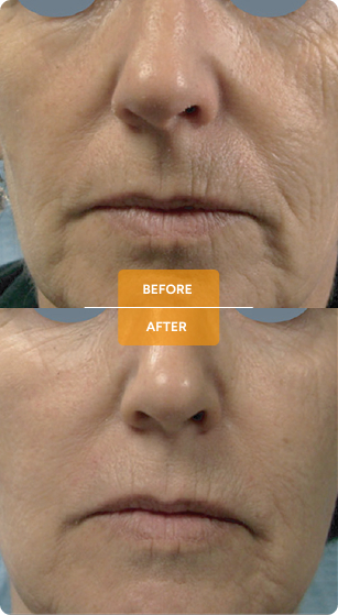 Tixel® for skin rejuvenation before and after case 8
